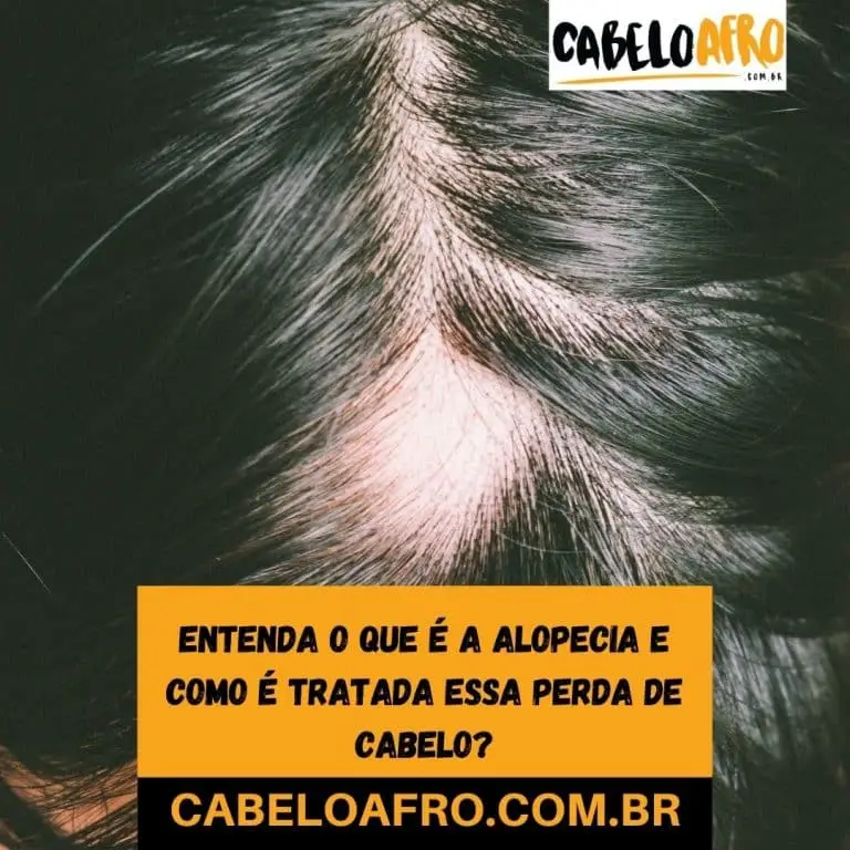 Entenda o que é a Alopecia e como é tratada essa perda de cabelo?