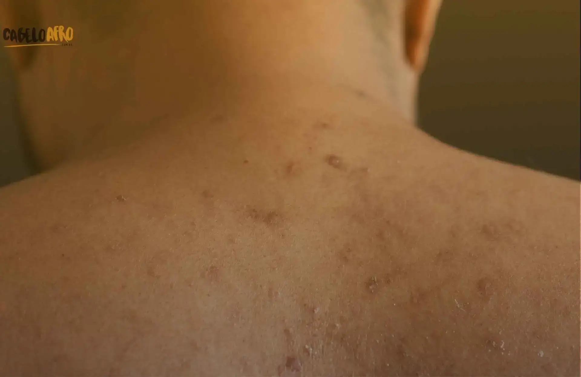 Produtos naturais para manchas na pele negra